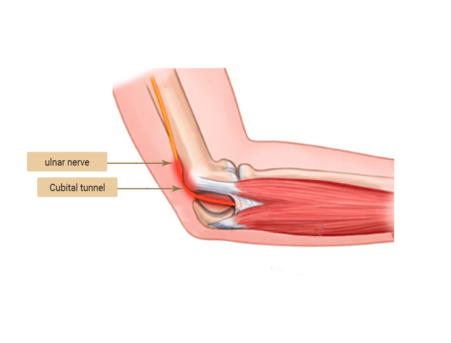 Cubital tunnel syndrome (ulnar nerve compression neuropathy)