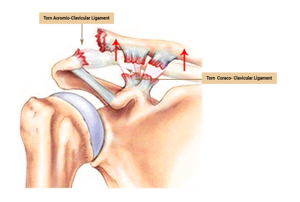 AC Joint Reconstruction